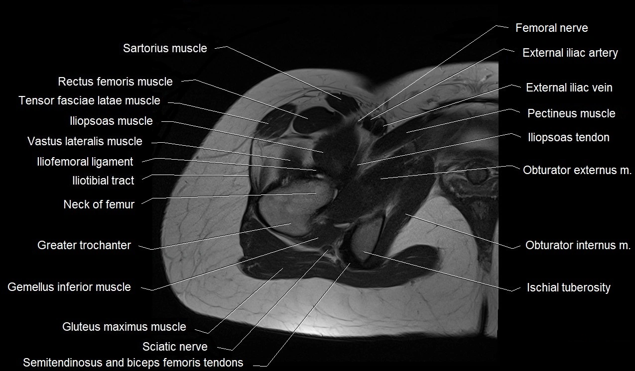 MRI thigh cross sectional anatomy image 10.webp